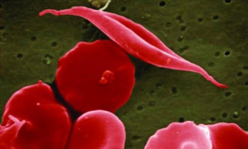 Gene therapies for sickle cell disease approved