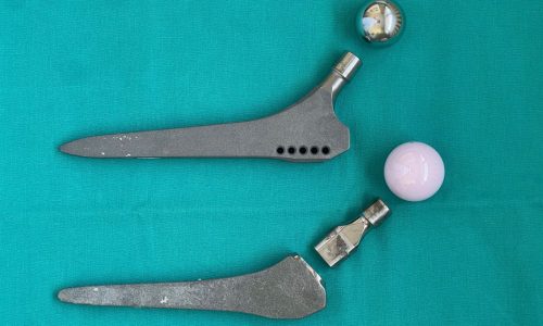 Patients expected Profemur artificial hips to last. Then they snapped in half