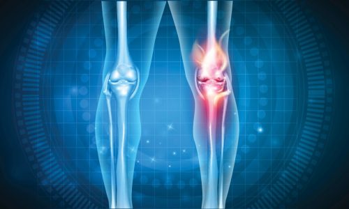 Knees stiff with arthritis? This company is studying whether fat injections can improve motion