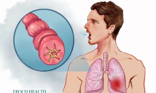 The Essential Guide to Asthma: Symptoms, Causes, Treatments, and Natural Approaches