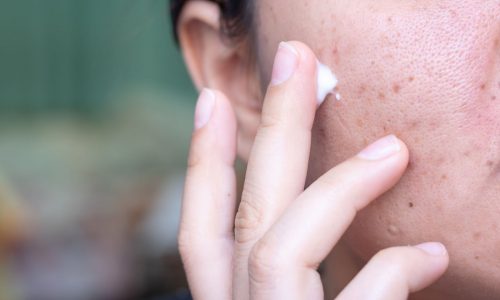 Doctors urge refrigerating acne creams to reduce cancer risk