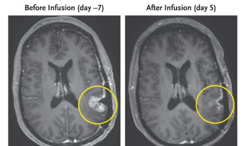 A promising glioblastoma clinical trial: Mass General cancer researchers say tumors dramatically shrunk