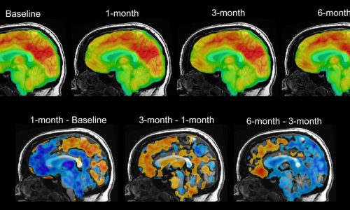 Anand Kumar: Premature Alzheimer’s diagnosis using pseudoscience is dangerous