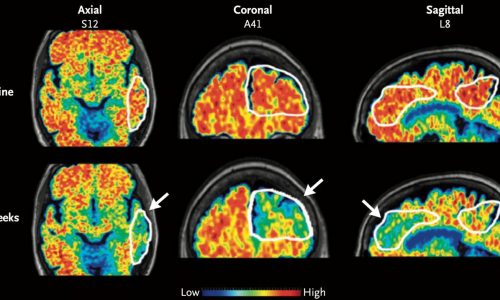 Alzheimer’s research: Boston scientists create AI model to ‘catch Alzheimer’s disease early’