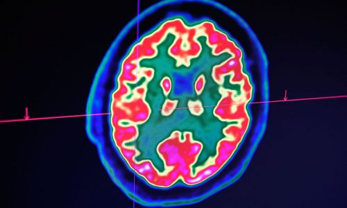 Alzheimer’s research: Scientists create AI model to ‘catch Alzheimer’s disease early’