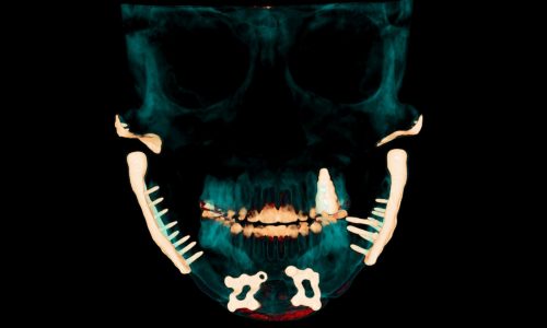 ‘A bottomless pit’: How out-of-pocket TMJ costs drive patients into debt