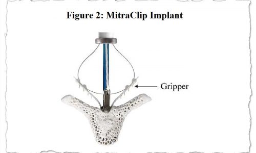 The FDA calls them ‘recalls,’ yet the targeted medical devices often remain in use