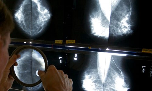 More young women are getting breast cancer, report