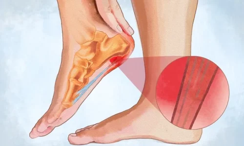Plantar Fasciitis: Symptoms, Causes, Treatments, and Natural Approaches