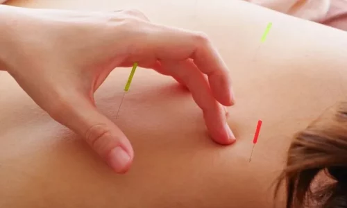Acupuncture Proven Effective for Sciatica: Clinical Trial