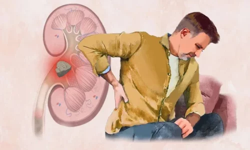 Kidney Stones: Symptoms, Causes, Treatments, and Natural Approaches