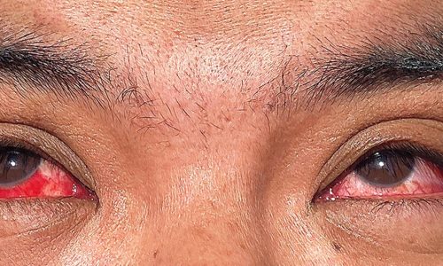 How America lost control of the bird flu, setting the stage for another pandemic