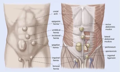 Hernia: Symptoms, Causes, Treatments, and Natural Approaches