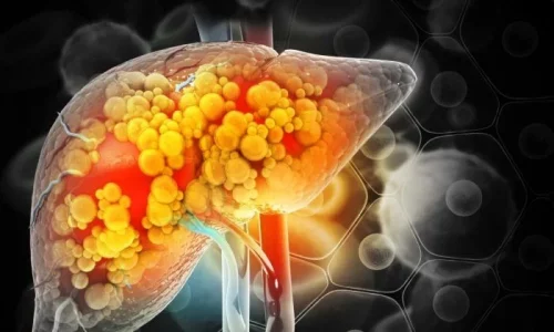 Over 40 Percent of US Adults Are at Risk of Liver Disease by 2050, Study Warns