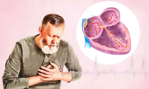 Atrial Fibrillation: Symptoms, Causes, Treatments, and Natural Approaches