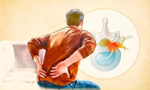 Herniated Disk: Symptoms, Causes, Treatments, and Natural Approaches