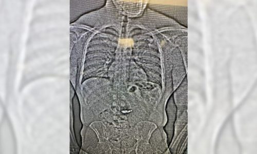 X-ray shows diamond earrings swallowed by theft suspect during arrest, police say