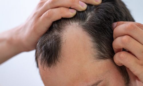 Shampoos for treating hair loss: Pros, cons, and do they work?