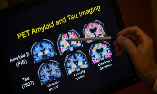 Alzheimer’s disease study: researchers create at-home smell test for early detection