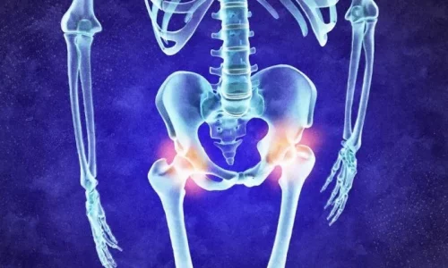 Osteoarthritis: Gene Study Finds New Drug Targets and Treatment Options