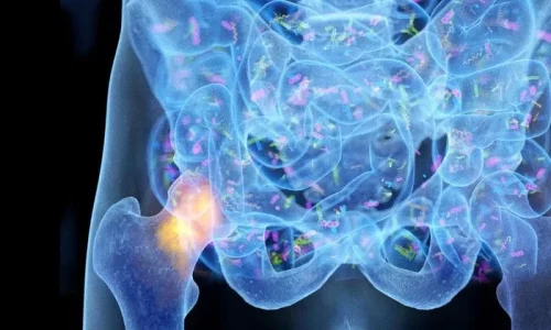 An Overlooked Driver of Osteoporosis