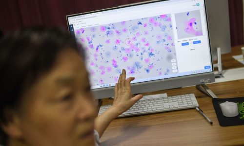AI eroded doctors’ ability to spot cancer within months in study