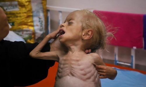 Malnourished kids arrive daily at a Gaza hospital as Netanyahu denies hunger