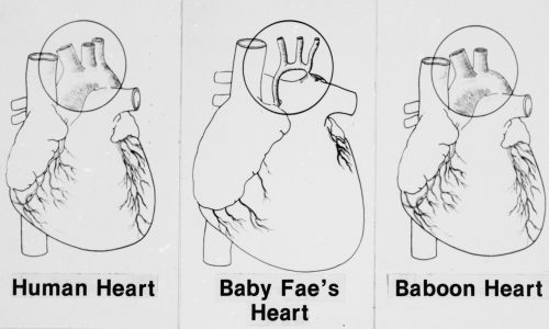 Today in History: October 26, Newborn receives baboon heart in experimental transplant