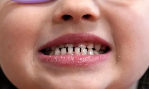 FDA restricts use of kids’ fluoride supplements citing emerging health risks