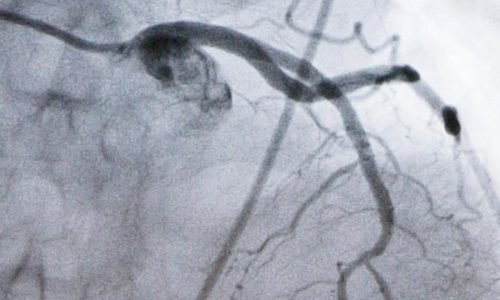 Experimental cholesterol-lowering pill may offer new option for millions