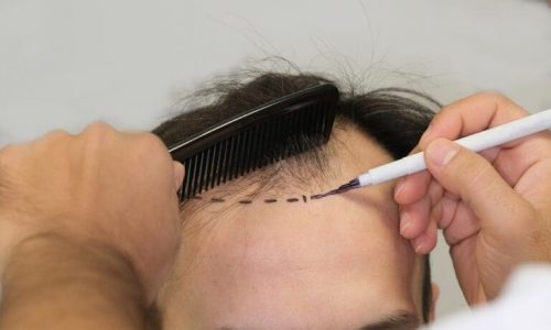 Top 5 Hair Transplant Clinics in Turkey for Celebrity-Grade Results