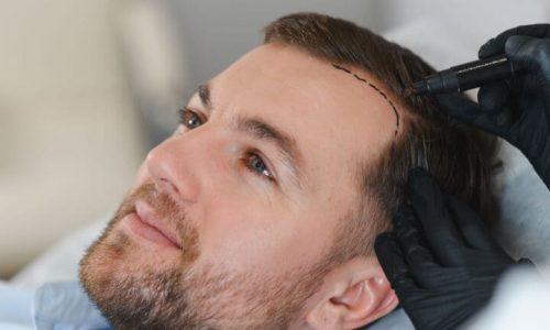 Top 10 Best Hair Transplant Clinics in Turkey