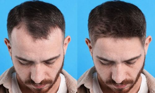Top 10 Best Hair Transplant Doctors in Turkey: A 2026 Guide to Surgeons